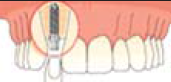 Sostituzione dente singolo