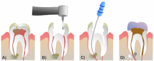 endodonzia