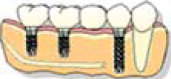 Sostituzione di più denti