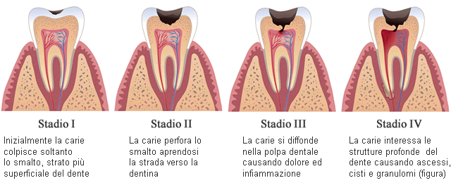 conservativa carie-dentale