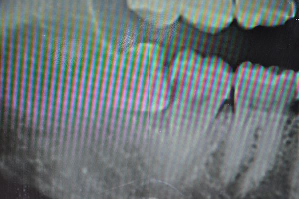 rx-endorale-particolare-dente-del-giudizio-inferiore