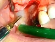 Video rialzo del seno mascellare con piezosurgery