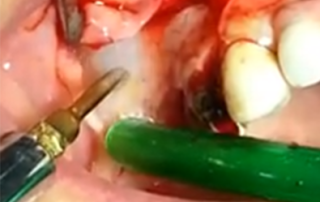 Video rialzo del seno mascellare con piezosurgery